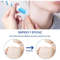 Kit removedor de verrugas